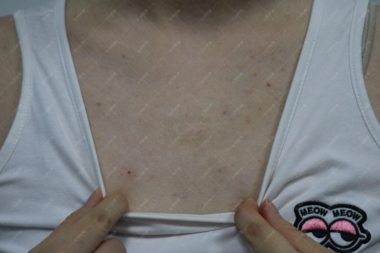 疤康医院治疗疤痕大概多少钱,祛疤灵能去除疤痕吗