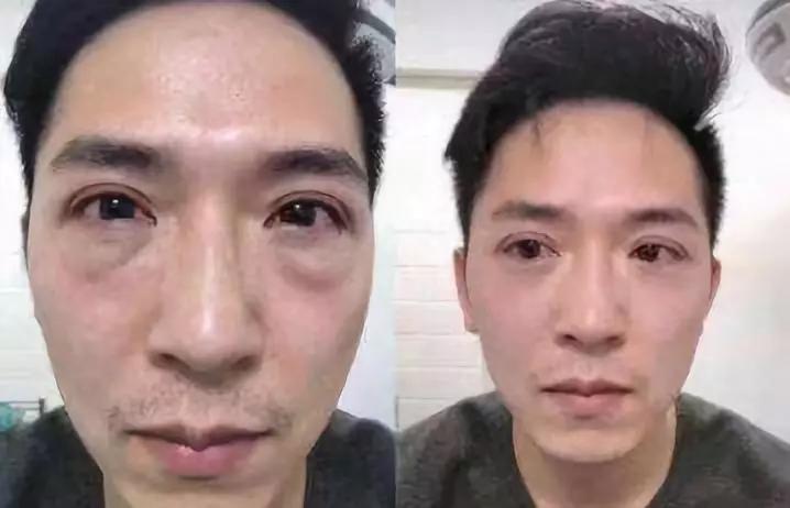 眼袋越来越严重怎么救,有眼袋显老十岁一招教你消除