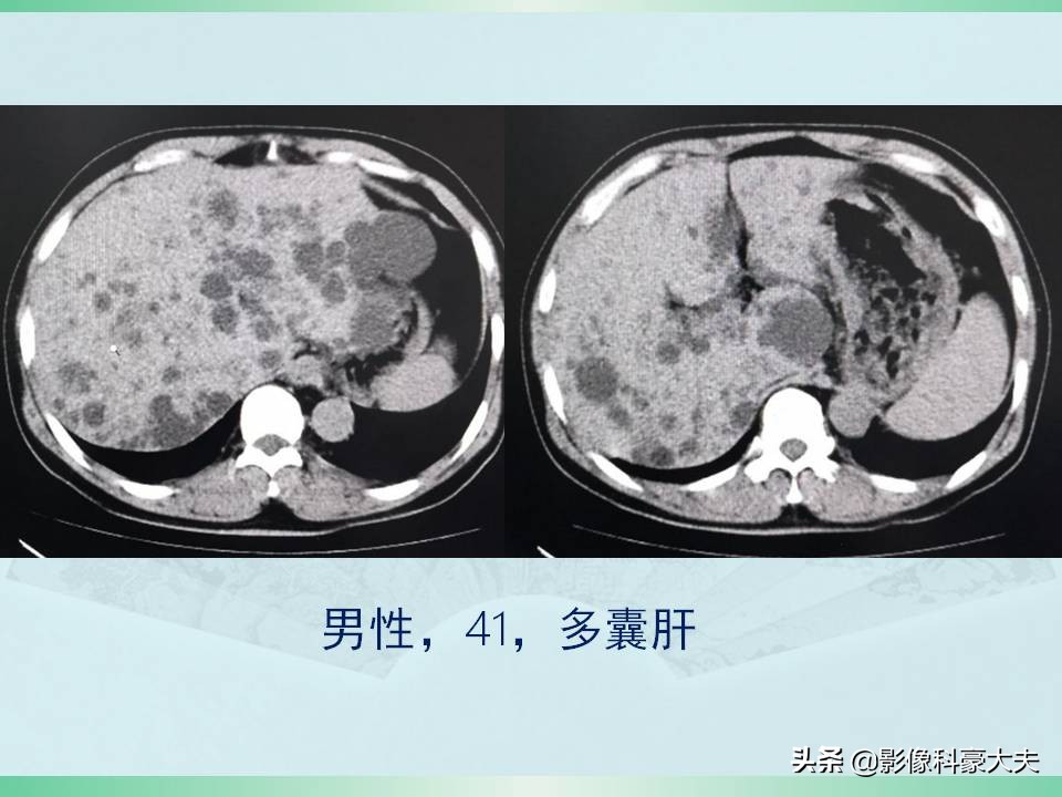 得了尿毒症又得了癌症怎么办,尿毒症为什么发病大多是年轻人呢