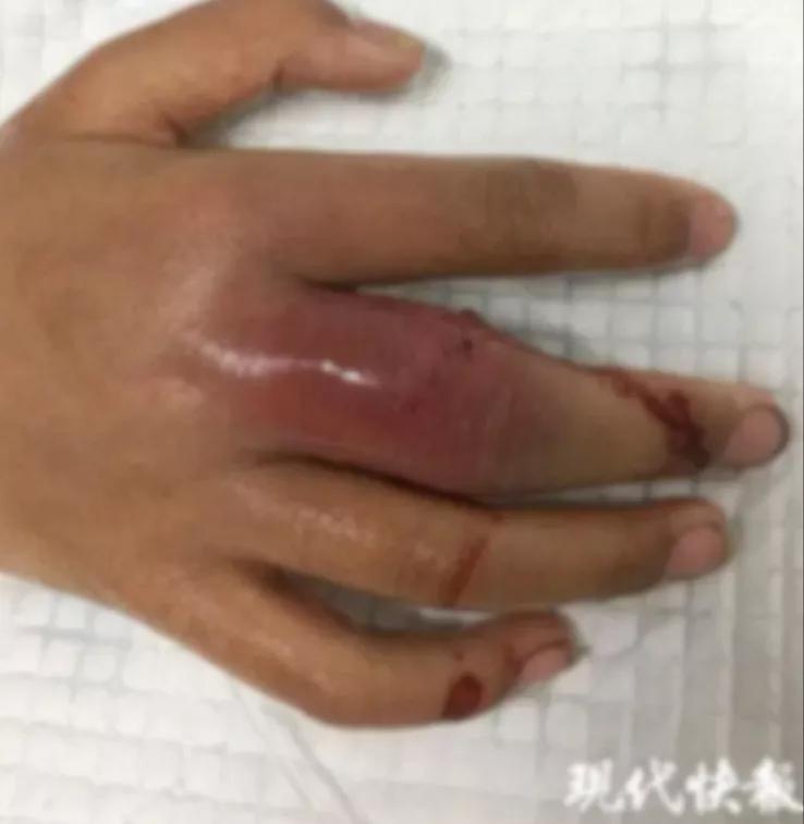 与它“握”了个手，男子手指红肿溃烂！医生：别大意