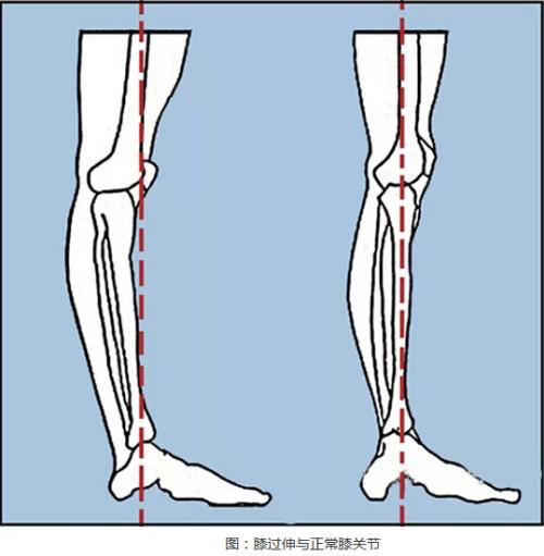 膝过伸康复方法,膝过伸有调整好的吗