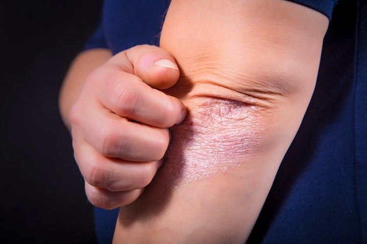 益阳治疗银屑病,650万银屑病患者的斑斓人生