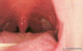 咽喉疾病科普知识,咽喉疾病动画科普视频