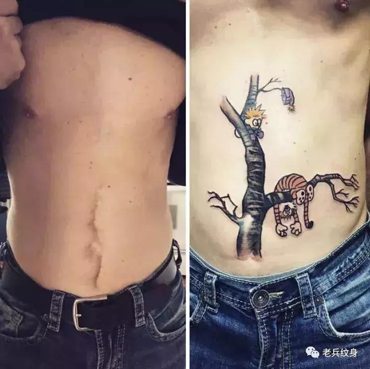 疤痕体质可以用纹身去遮盖疤痕吗,你的疤痕是什么颜色呢