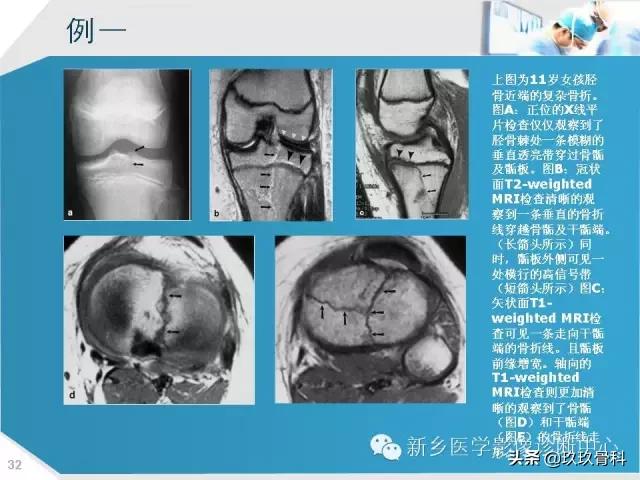 骨骺损伤x线表现,骨骺损伤磁共振表现