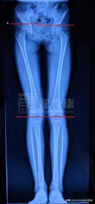 26岁长短腿脊柱侧弯可以矫正吗,脊柱侧弯会怎么治疗