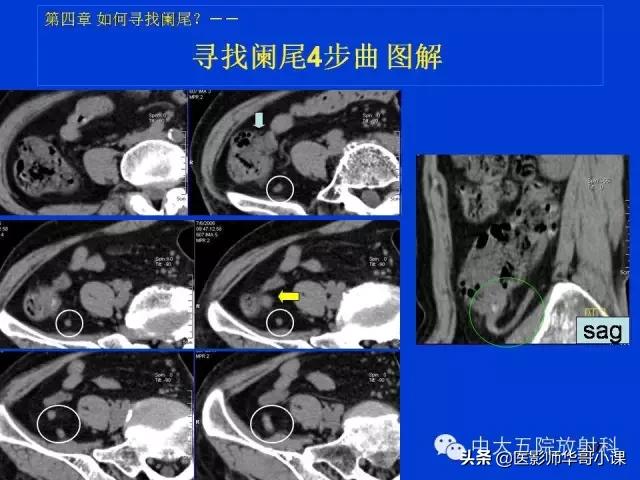 阑尾炎课件,阑尾炎的超声课件
