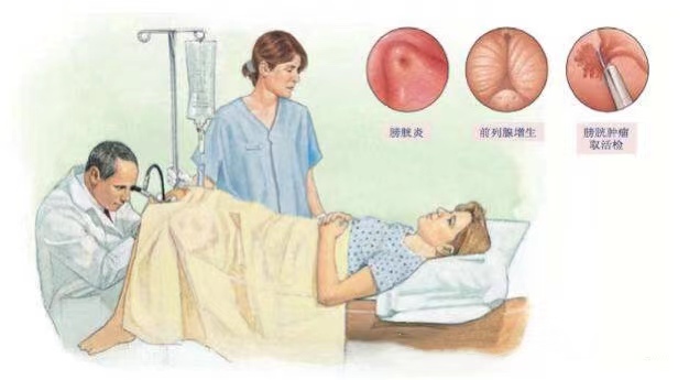 膀胱癌血尿的两个特点,诊断膀胱癌最有意义的诊断方法