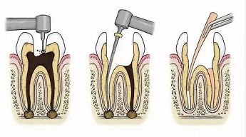 牙疼就必须做根管治疗了吗,牙疼医生说要做根管治疗