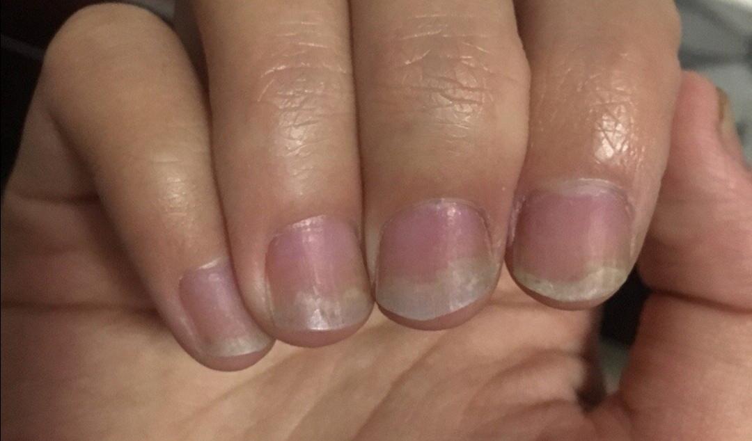 指甲上有条纹要警惕,指甲出现哪些症状是有问题的