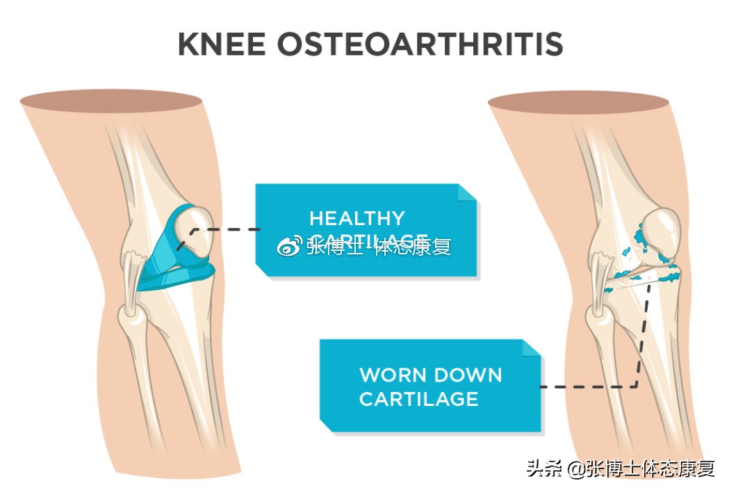 【运动康复科普】为什么你的膝关节内侧会出现疼痛？