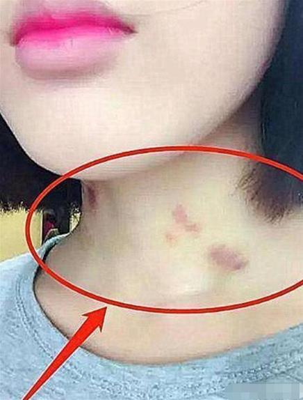 13岁女生脖子被种“草莓”，妈妈再三追问，孩子的回答让妈妈心酸