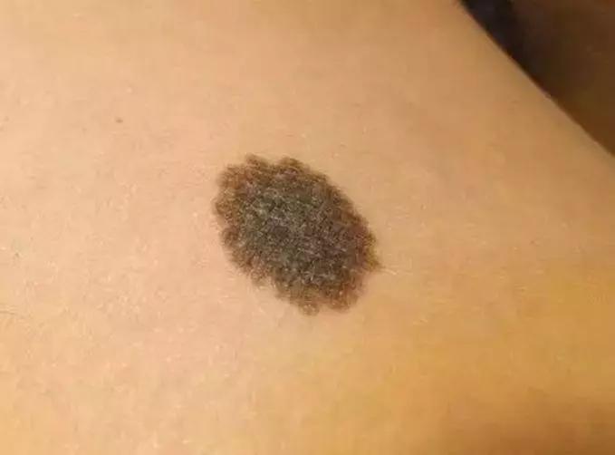 宝宝身上的胎记有问题吗,宝宝身上胎记很多是怎么回事