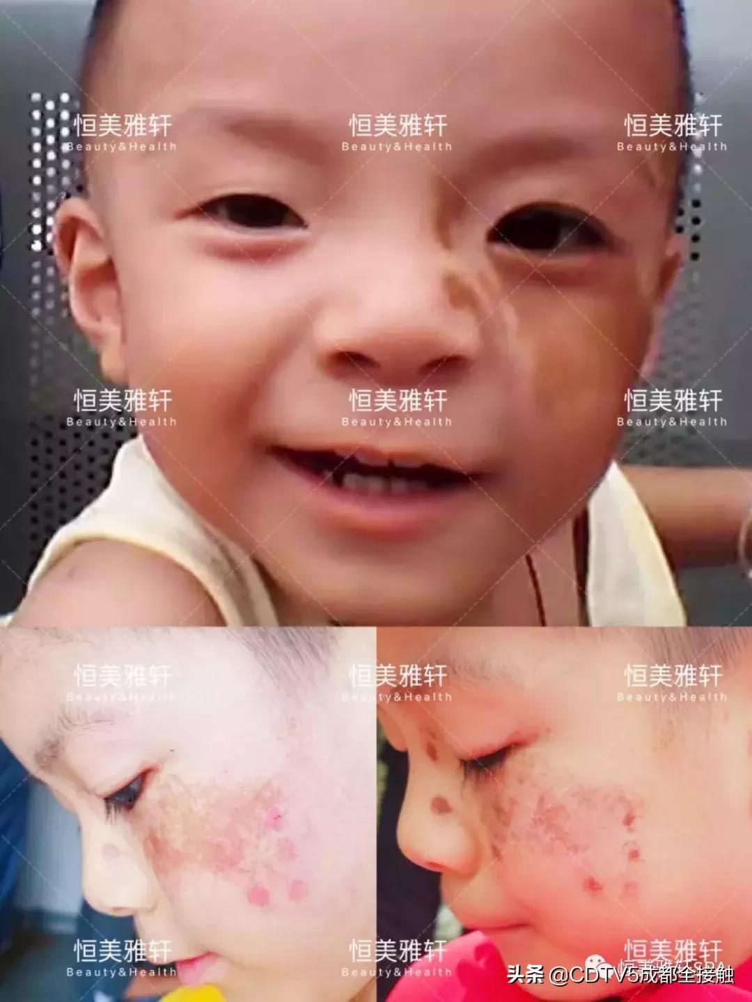 恒美胎记,恒美公益