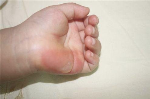 三岁女童手指被压断后续,小孩手指被夹伤需要多久才能恢复