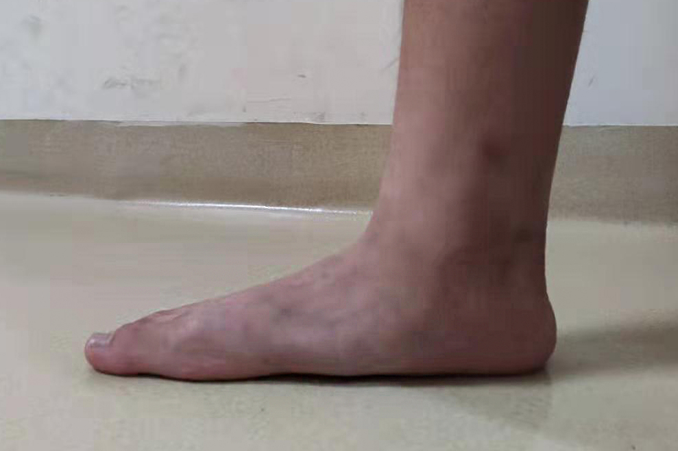 扁平足如何影响体态,扁平足会影响长高吗