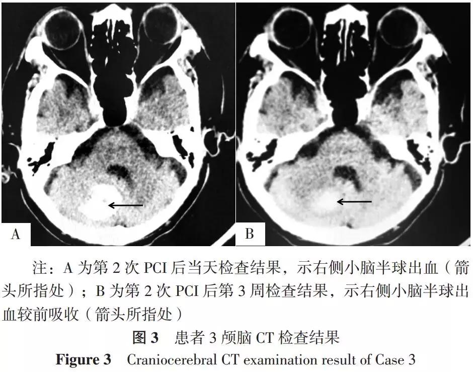 pci术后脑出血症状,脑出血案例分享