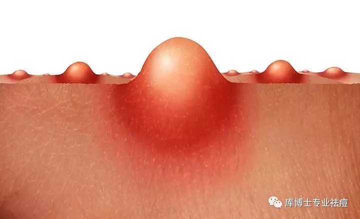 红蓝光针清祛痘效果怎么样,库博士专业祛痘湛江