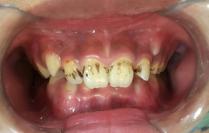 牙齿发黑是什么原因,宝贝牙齿黑了用什么牙膏最好