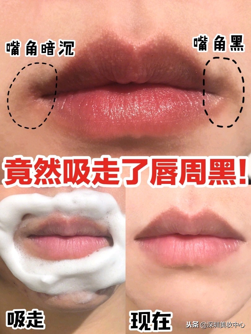 种草：嘴角、唇周围发黑，变白有招，温和不伤肤！