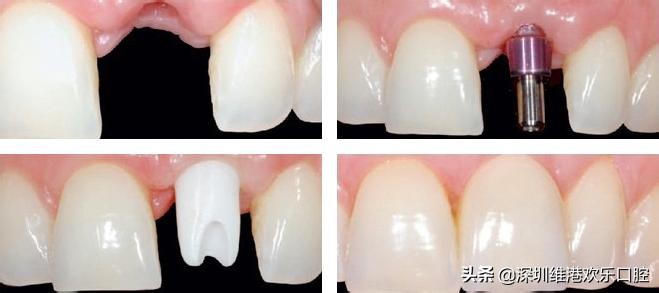 全部种植牙的危害,做种植牙有什么危害