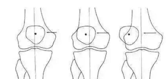 膝盖打软是髌骨错位吗,膝盖髌骨软化酸胀三个月能锻炼吗