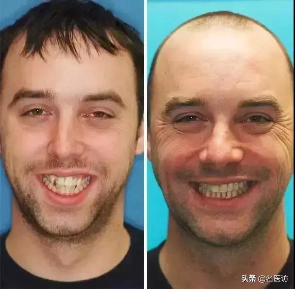 牙齿矫正换脸视频,牙齿矫正颜值有多大改变图片
