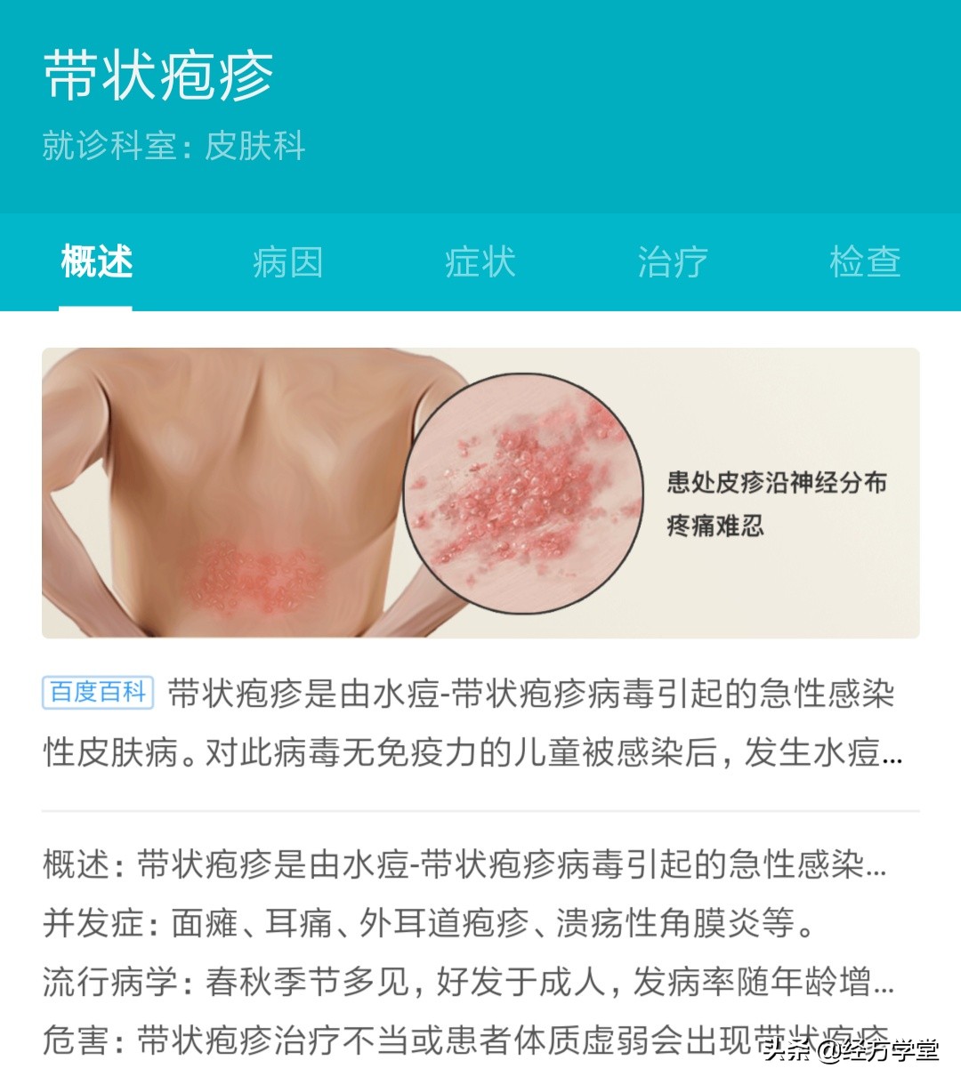 古籍医书治带状疱疹,国家级名老中医治疗带状疱疹经方