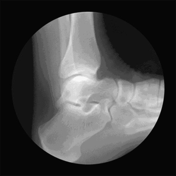 骨科张医生骨质增生,骨科赵医生骨质增生