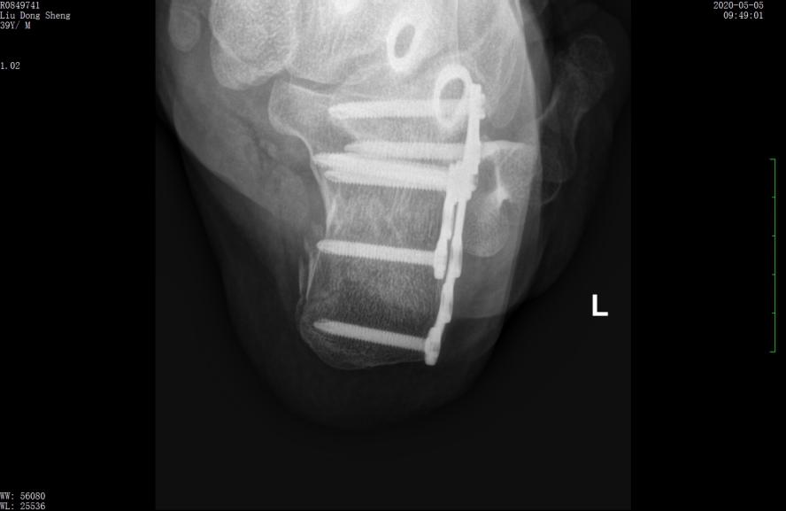 左股骨粗隆间粉碎性骨折微创手术,跟骨粉碎性骨折微创手术最快多久