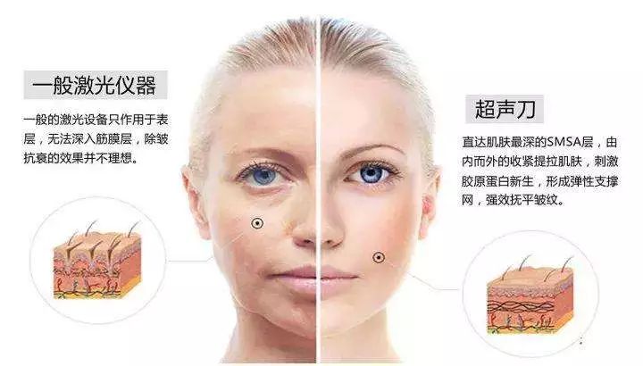 超声刀会使脸变得特饱满,超声刀能抚平皱纹吗