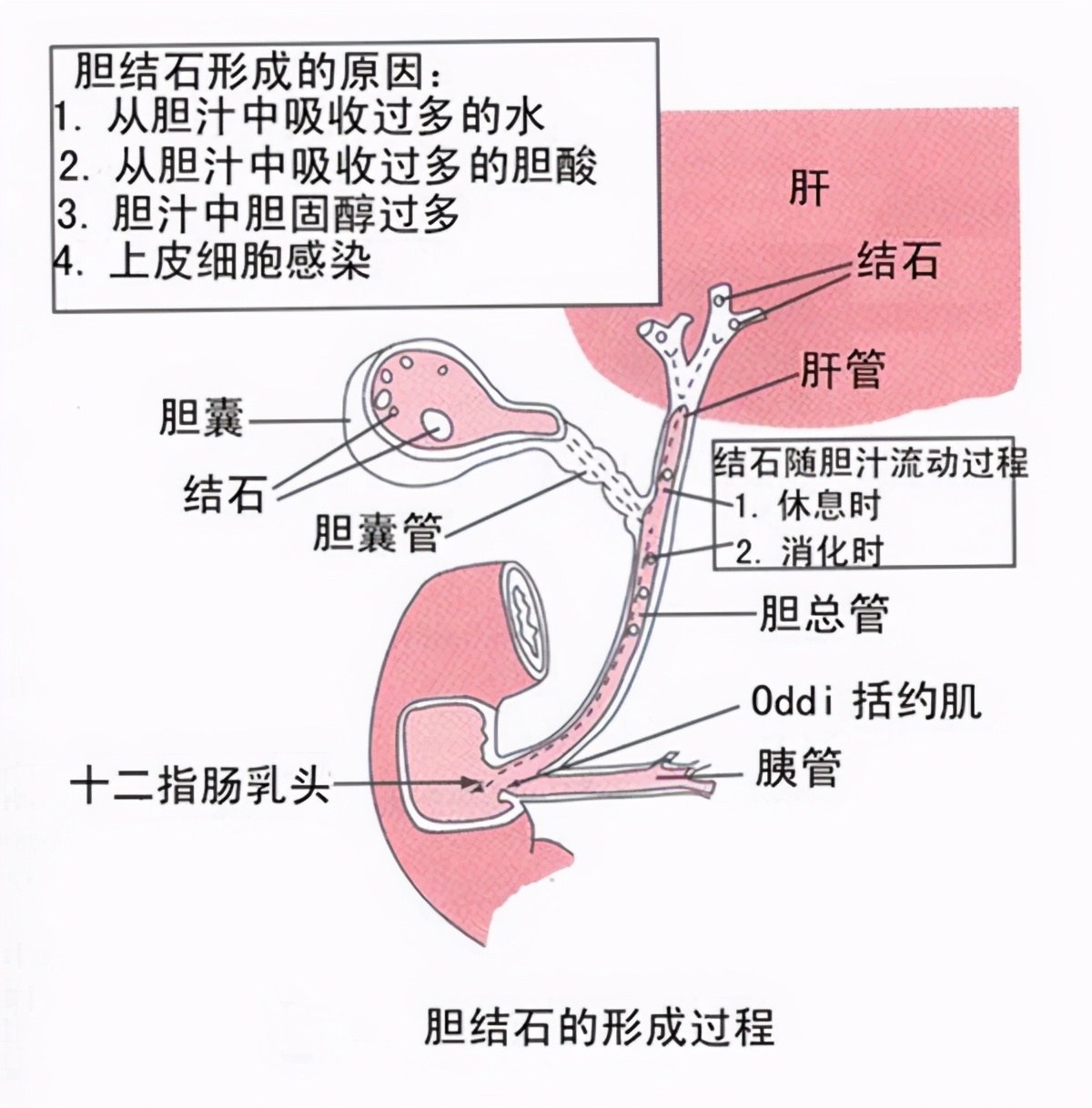 胆囊炎吃鸡蛋会是什么症状,胆囊炎胆结石能吃鸡蛋吗