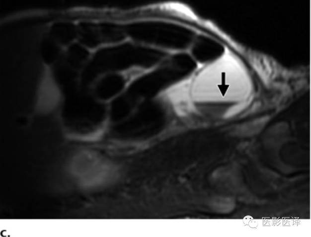 孕早期卵巢囊肿边界清形态规则,孕期卵巢囊肿呈液性伴点状回声