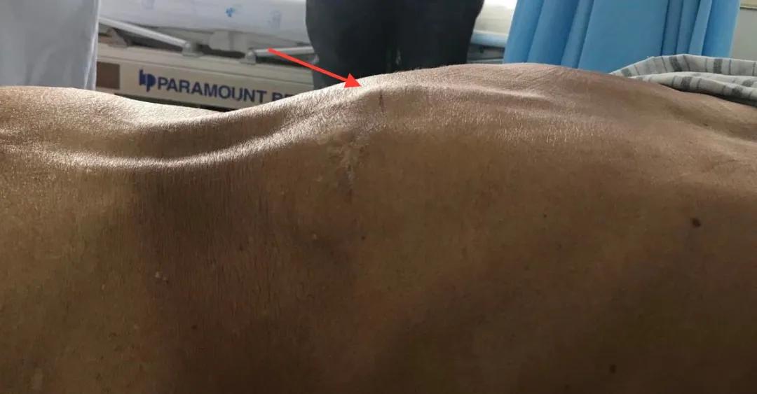 腰椎结核会引起哪些症状,久坐腰疼是腰椎结核么