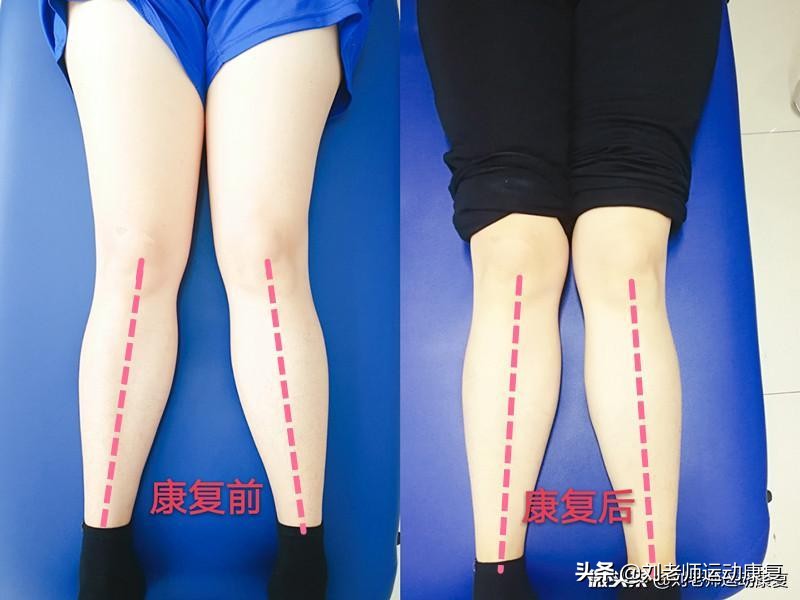 如何矫正xo腿型科学方法,康复科医生教你怎么矫正腿型