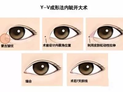 开内眼角会遗留明显疤痕吗,十个开眼角十个留疤