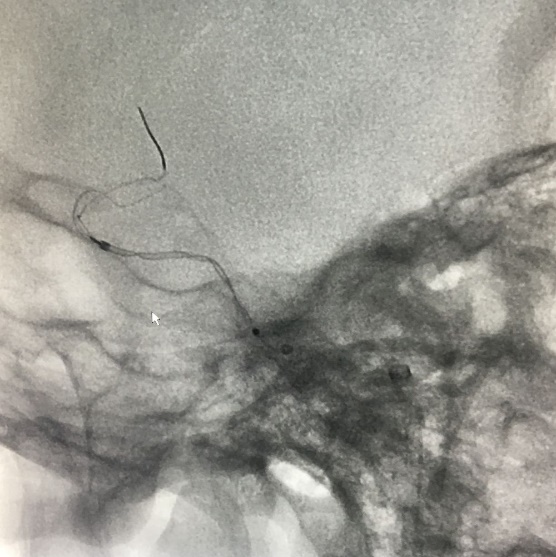 Tubridge®治疗多发性动脉瘤