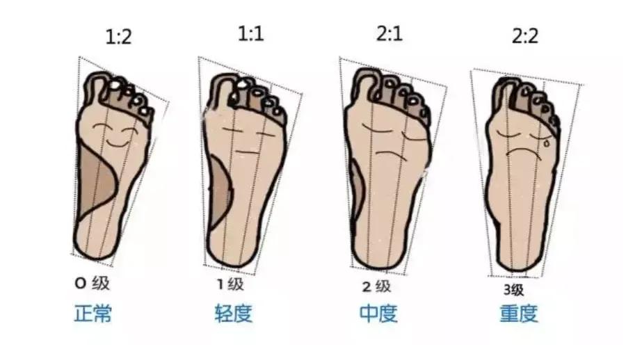 如何判断扁平足是先天还是后天,扁平足简单自测
