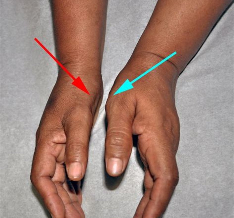 手麻是什么原因造成的怎样治疗,手麻是五种原因引起的要警惕