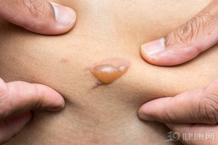 烫伤急救正确步骤5字,烫伤急救五步法宣传