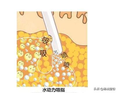 大腿吸脂找哪个医生做,大腿吸脂多久可以打瘦腿针