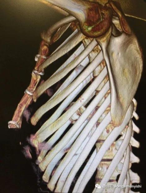 温岭手术多少钱,wenlin手术怎么样