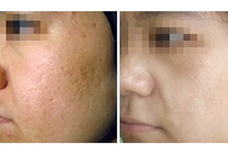 女士夏季去痘印毛孔堵塞贴面膜,脸上痘印怎么最快淡化小窍门