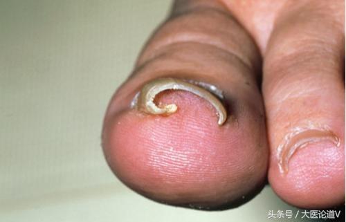 健康的脚什么形状,健康脚的重要性你知道吗