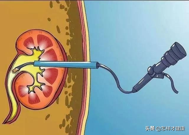 尿路结石疼痛一招搞定是真的吗,尿路结石疼痛怎么止痛最快