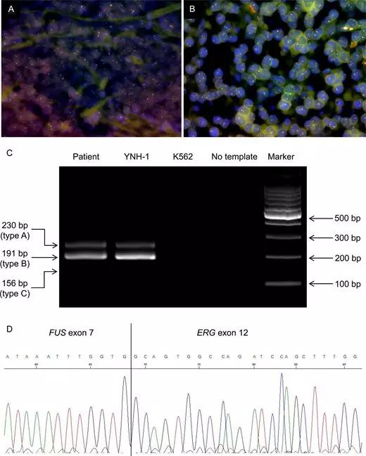 髓样肉瘤,髓系肉瘤合并髓系白血病