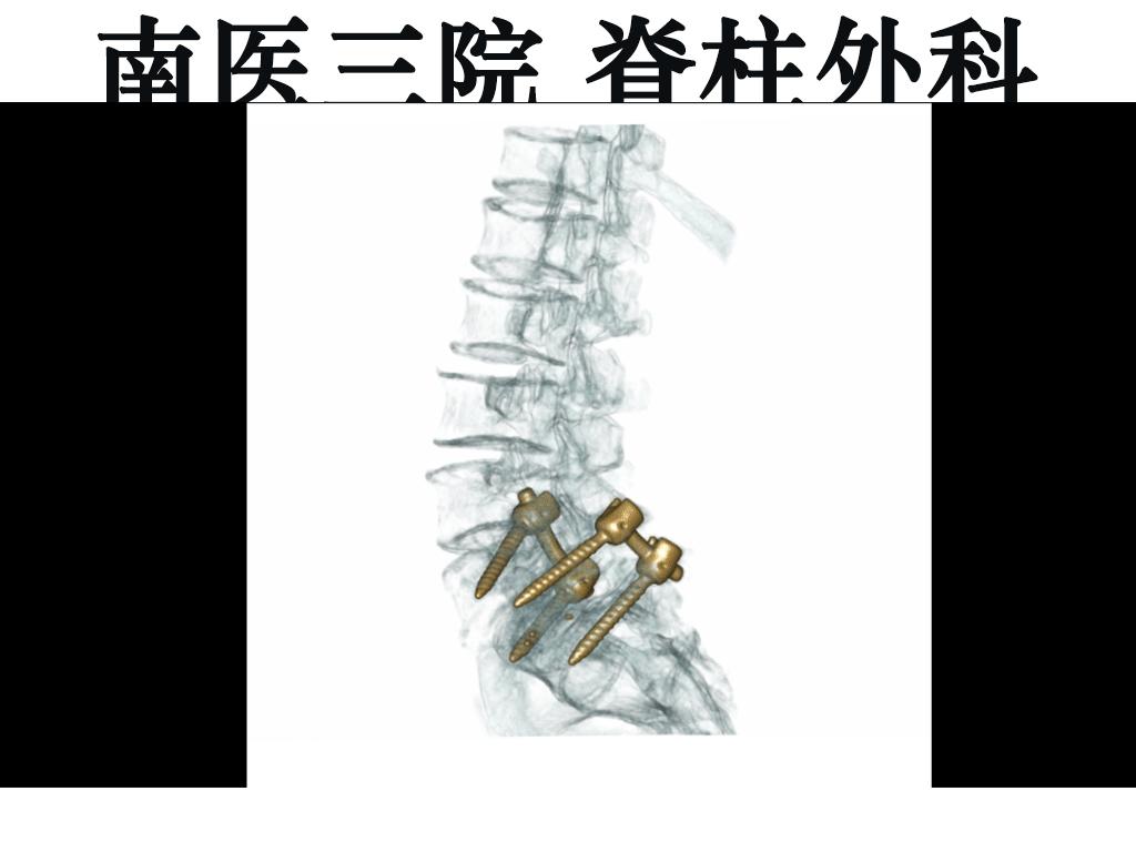 腰痛引起腰椎滑脱怎么治,十七岁腰椎痛怎么办