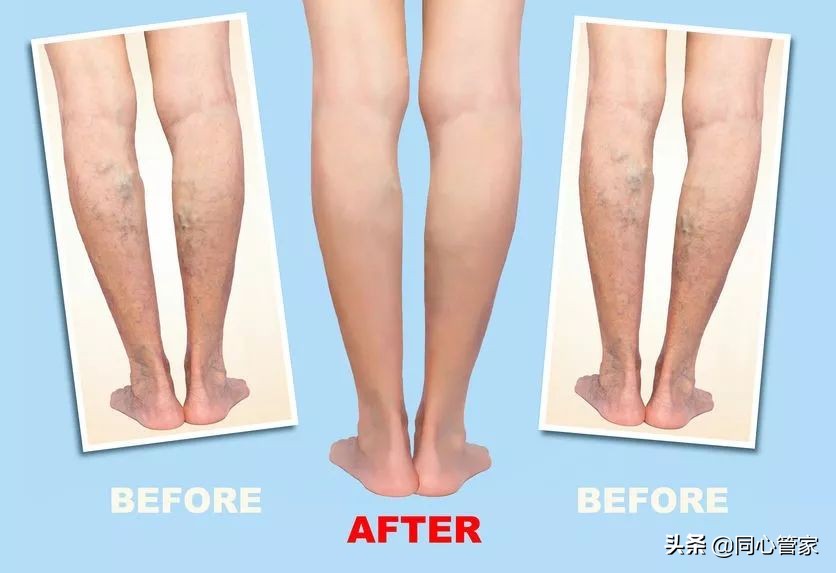 是不是有的血栓也不要过度治疗,能彻底治疗血栓吗