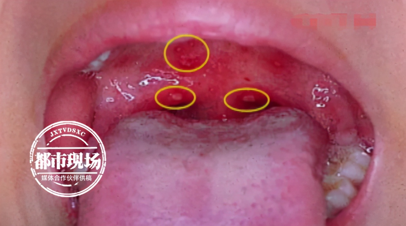 孩子突然发烧不用慌,感冒咽喉痛发烧37.5左右