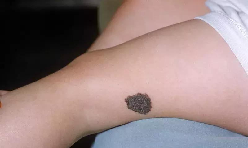 医生如何判断痣切干净了没,医生如何判断痣与黑色素瘤